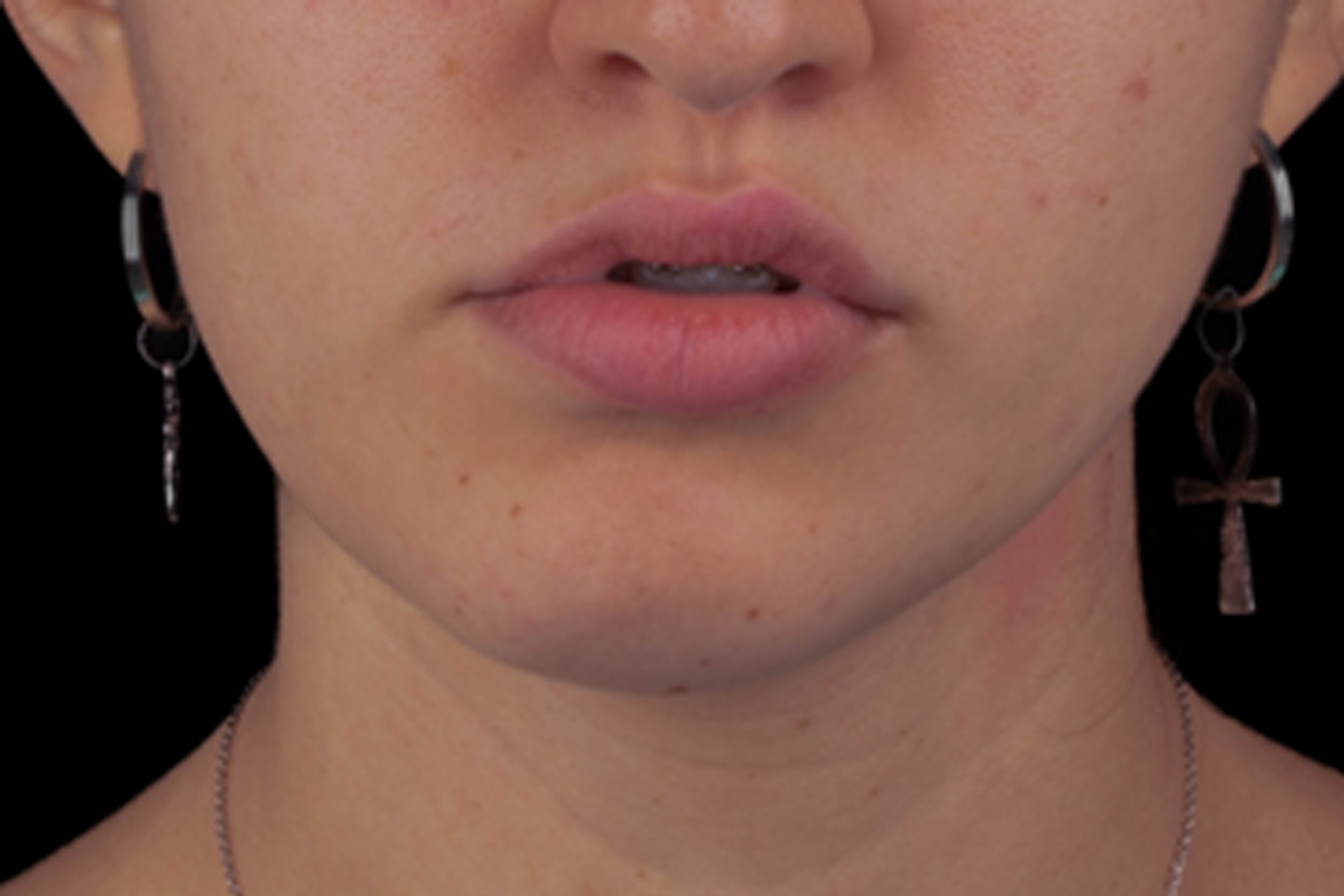 Imagem do blog - Post 01 sobre cirurgia bucomaxilofacial