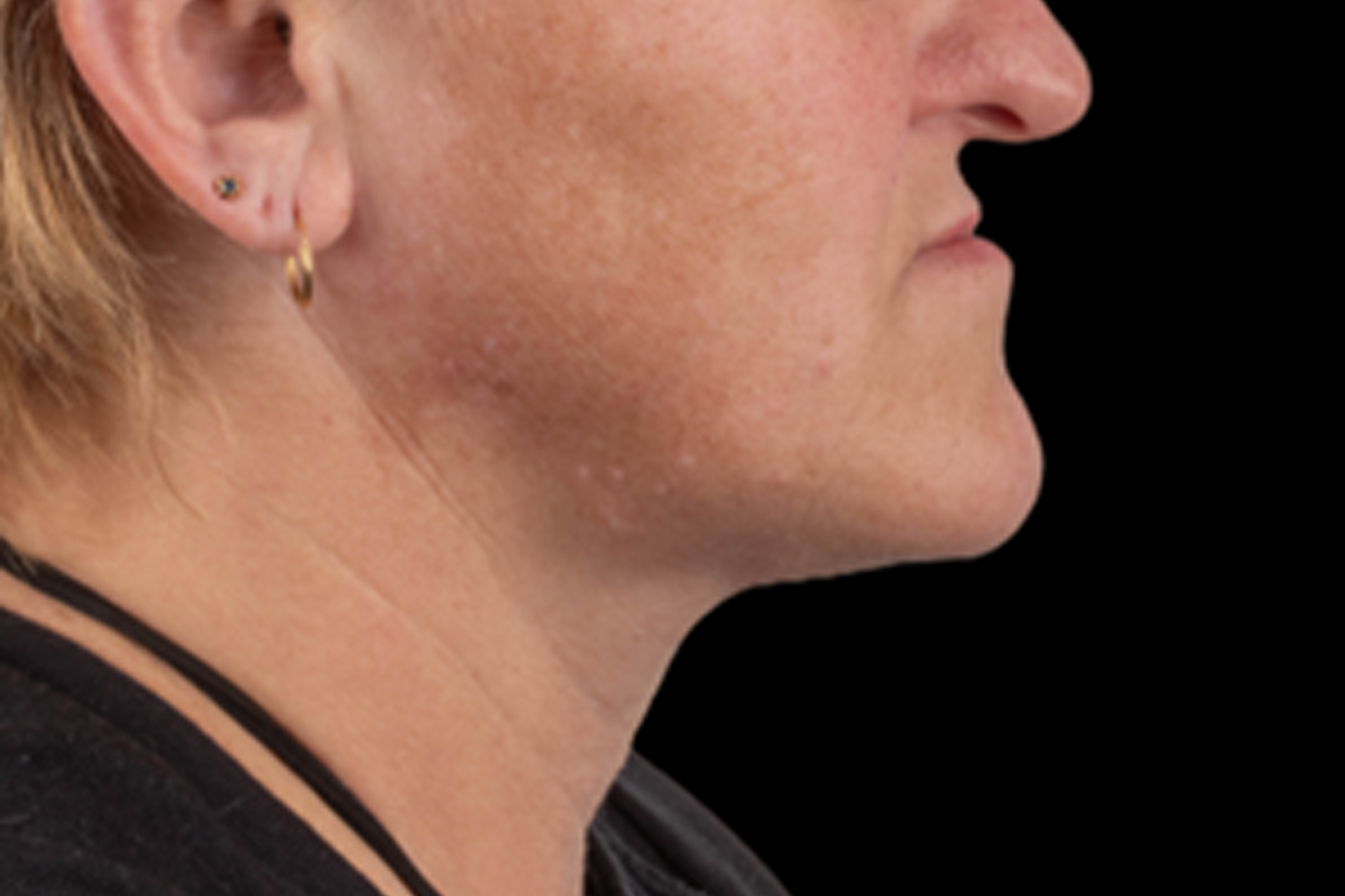 Imagem do blog - Post 02 sobre procedimentos faciais