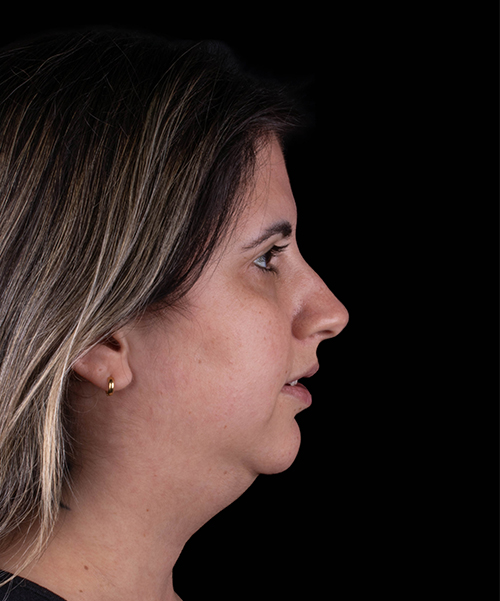 Antes da Cirurgia Ortognática - Paciente 3